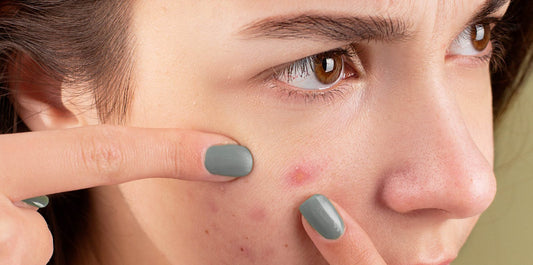 5 Effektive Tipps zum Umgang mit jugendlicher Akne: Ihr Weg zu einer klareren Haut